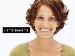 Dental Implants. Learning Objectives Understand basic terminology and  components of a dental implant including: Process Implant materials  Advantages of.