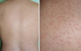 You should always speak with your doctor before you follow anything that you read on this website. Fungal Acne Causes And Treatments Mdacne