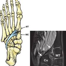 An mri will confirm the diagnosis and allow differentiation of other causes of masses in the foot, such. Pdf Plantar Tendons Of The Foot Mr Imaging And Us