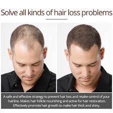 Growing a thicker beard can be hard for some men. Vibrant Glamour Hair Growth Liquid Nourish Hair Roots Thick And Shiny Prevent Hair Loss Anti Hair For Men Women Natural Plants Hair Scalp Treatments Aliexpress