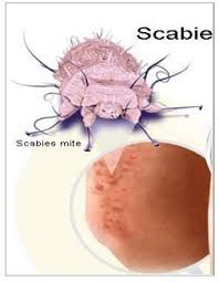 Image result for scabies in the groin area