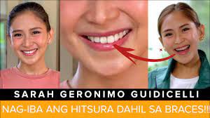 May chance ka pa kasi the promo deadline is extended until july 31, 2021! Netizens Hindi Umano Bagay Ang Braces Ni Sarah G Sarah Geronimo Youtube