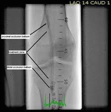 Above the Knee Peripheral Artery Intervention