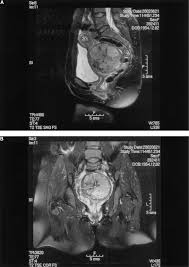 Image result for Leiomyosarcoma
