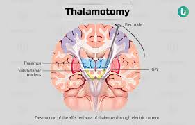 Image result for Thalamotomy