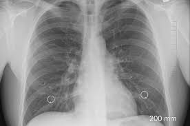 La analizele de sânge poate fi detectata o embolia pulmonara. Sechele Pulmonare DupÄ Covid 19 Ne Temem De ApariÈia Unei Noi Boli Smart Radio