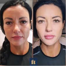 💉 7 POINT FACELIFT 💉 . . We are really missing our clients and our little  Facetherapy family so here is a little throwback to this beauty our  favourite client @thesculptedvegan ! . .