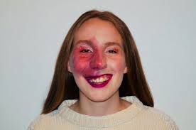 Student says abuse from strangers won't make her cover up birthmark