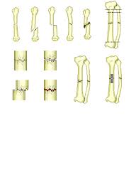 types of bone fractures interactive anatomy guide