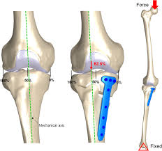 Below the gluteus maximus is the smaller gluteus medius. Biomechanical Effect Of A Lateral Hinge Fracture For A Medial Opening Wedge High Tibial Osteotomy Finite Element Study Journal Of Orthopaedic Surgery And Research Full Text