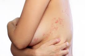 Image result for shingles