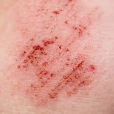 Erkrankt jedoch eine schwangere frau, kann das ungeborene kind schwere schäden erleiden. Blut Apotheke Am Forum Munchen