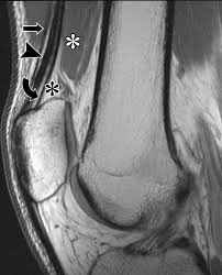8 = medial collateral ligament. Layered Approach To The Anterior Knee Normal Anatomy And Disorders Associated With Anterior Knee Pain Radiographics
