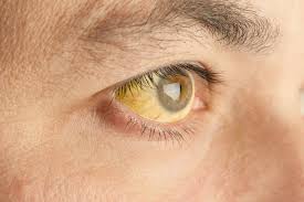 In acute liver failure, jaundice occurs rapidly, often in concert with gastrointestinal symptoms like vomiting and fever. Symptoms Of Hyperbilirubinemia Elevated Bilirubin