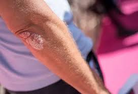 Image result for psoriasis
