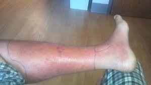 Mommy Medicine A Common But Deadly Infection Staph Infection Cellulitis Infection Bacterial Infection