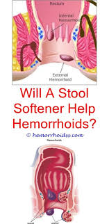 Can Hemorrhoids Cause Thin Stools Hemorrhoids Treatment Cure For Hemorrhoids Bleeding Hemorrhoids