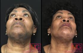 Home remedies to manage them naturally. African American Skin Treatment Dermatology Nyc Dr Michele Green M D