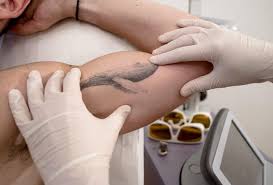Laser tattoo removal, which is the most common method, and usually the best, ranges from $200 to $500 per session. Laser Tattoo Removal In Lyon At The Lyon Laser Center