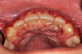 Image result for Oral herpes roof of mouth