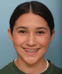 Otoplasty Before & After Photos