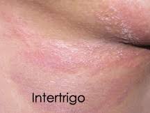 Image result for Intertrigo under breasts