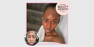 An overview of eczema on the face. How To Get Rid Of Eczema One Woman S Story