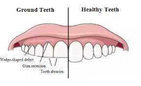 What Is Wedge Shaped Defect Dental Fillings Dental Problems Teeth Alignment