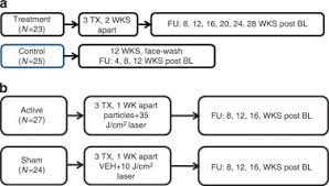 acne treatment based on selective photothermolysis of