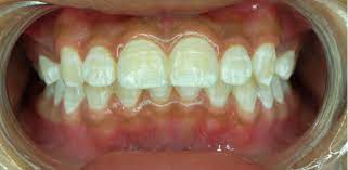This tooth powder uses bentonite clay as its main ingredient along with more or less the similar ingredients that are being used in making remineralizing toothpaste. How To Get Rid Of White Spots On Teeth 8 Treatments Az Dentist