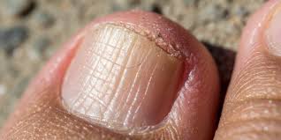 Image result for Pitting nails feet
