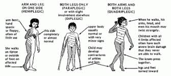 Apa yang dimaksud dengan cerebral palsy di abad kedua puluh satu? Cerebral Palsy S Rujito S Webblog