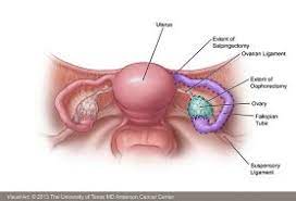 These may include advanced surgical procedures, chemotherapy options and targeted surgery often is needed for an ovarian cancer diagnosis, and it often is the first line of treatment. Ovarian Cancer Symptoms Diagnosis Treatment Md Anderson Cancer Center