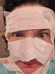 Co2 laser facial results after 10 days