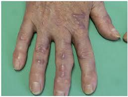 Recently, intralesional immunotherapy by different antigens has been associated with. Combination Of Surgery And Nd Yag Laser Therapy For Recalcitrant Viral Warts A Successful Therapeutic Approach For Immunosuppressed Patients Html Acta Dermato Venereologica