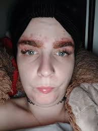 Mum left 'looking like Quasimodo' after horrific allergic reaction to  eyebrow tint