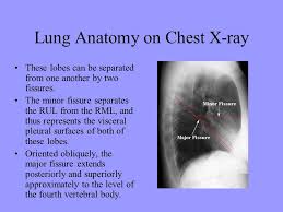 Anatomy of chest x ray. The Chest X Ray Ppt Video Online Download