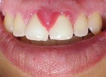 Glanda salivara inflamata tratament naturist. Hormonii Si Sanatatea Dentara Ce Trebuie Sa Stie Fiecare Femeie British Dental Place Stomatologie De Clasa Mondiala