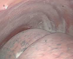 Here are some guidelines you should follow for h. Malignant Pleural Mesothelioma An Update On Investigation Diagnosis And Treatment European Respiratory Society