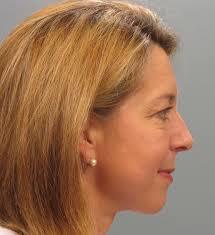 Eyelid Surgery Before and After Photos by Gregory Mackay, MD; Atlanta, GA