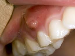 Recommend a ct scan.if the infection has spread to other areas within the neck, a ct scan may be used to assess the extent of the infection. Gum Boils What They Are And How To Treat Them