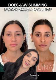 The Fern Technique: A Non-Surgical Laugh Line Treatment