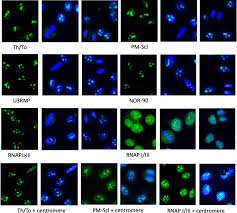 Image result for ANA Staining Pattern