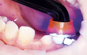 Image result for ochrana chrupu