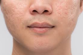 Your acne scars will fade over time—but these creams and serums can speed things up. A Dermatologist S Tips For Acne Scars Southwest Family Medicine Associates Family Medicine Physicians