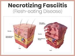 Necrotizing fasciitis is commonly caused by a group of organisms called group a streptococcus (gas) bacteria. Necrotizing Fasciitis Causes Symptoms Diagnosis Treatment And Prevention Boldsky Com