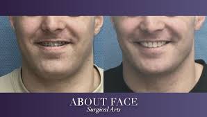 Does blue shield cover jaw surgery. Jaw Orthognathic Surgery About Face Surgical Arts
