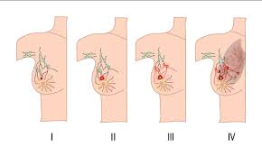 Image result for Breast Cancer Staging