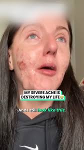 My Severe Acne Is Destroying My Life