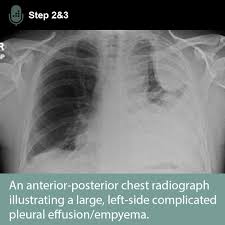 Image result for Parapneumonic Effusion